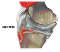 aspiration,acl injury,acl reconstruction india,acl reconstruction best india,acl reconstructionbest doctors in india,acl reconstruction best surgeon in india,acl reconstructionbest surgery in india,acl reconstruction best treatment in  india,acl reconstruction in south  india,acl reconstruction north  india,acl reconstruction  east india,acl reconstruction west india,acl reconstruction best in  india,acl reconstruction best surgery in india,acl reconstruction cost-effective in  india,acl reconstruction best doctors in india,acl reconstruction india,acl reconstruction india,acl reconstruction india,acl reconstruction now in india,acl reconstruction india,acl reconstruction by dr.bajaj,acl reconstruction by p.s.bajaj